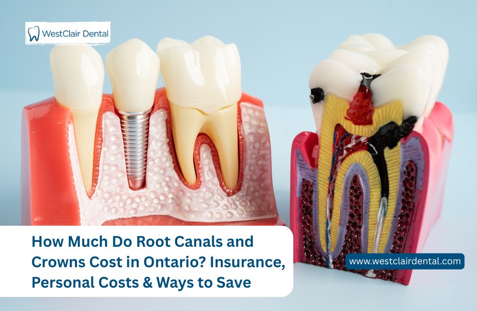 How Much Do Root Canals and Crowns Cost in Ontario? Insurance, Personal Costs & Ways to Save